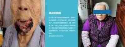 适温消融技术的临床应用