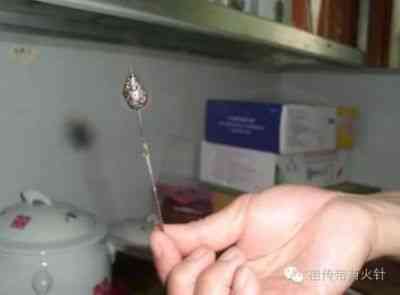 礼赞八一特别报道 祖传带药火针传承人——唐建华
